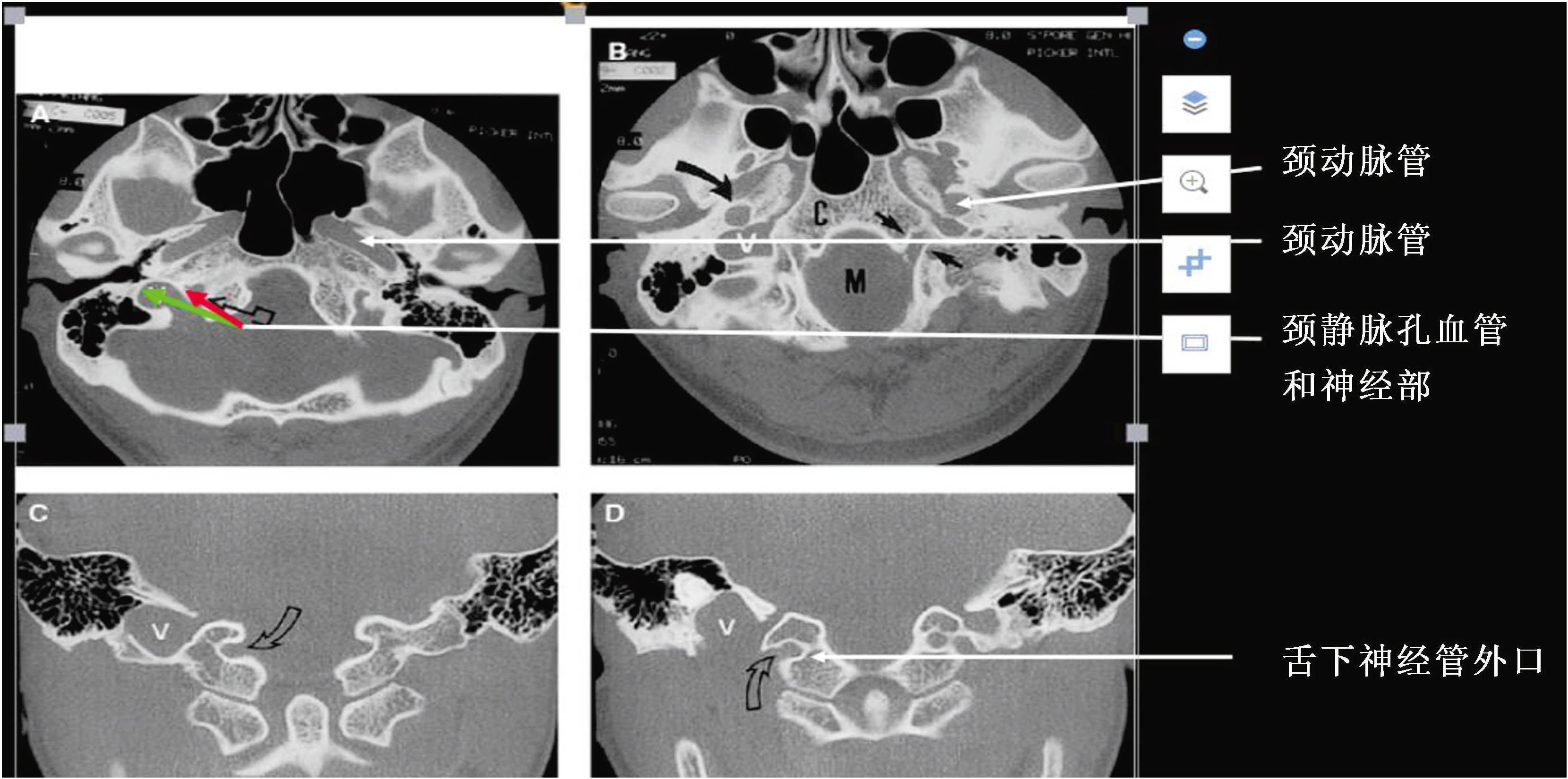 三、鼻咽部MRI(T<sub>1</sub>WI)影像